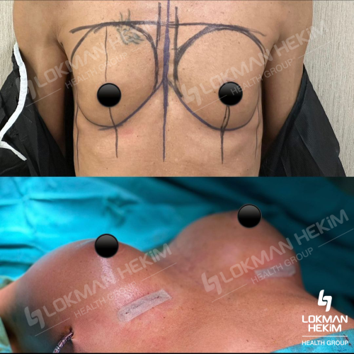 Mommy Makeover Surgery Before / After photo